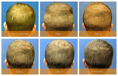 The Secret To Great Hair Transplant Results Hair Doctor Blog