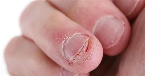 What Causes Red Fingernail Beds Design Talk