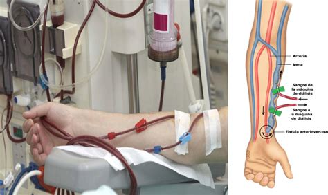 Fístula Arteriovenosas Para Diálisis Clínica Medivas