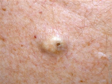 What Does A Cancerous Skin Lump Look Like Skin Epider