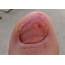 Pictures Of Toenail Fungus Is This What You Have  Clear Toes Clinic