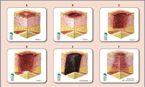 Skin Pressure Ulcer Stages