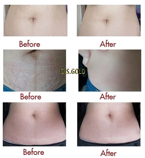 HOW TO GET RID OF STRETCH MARKS PERMANENTLY STRETCH MARK REMOVAL