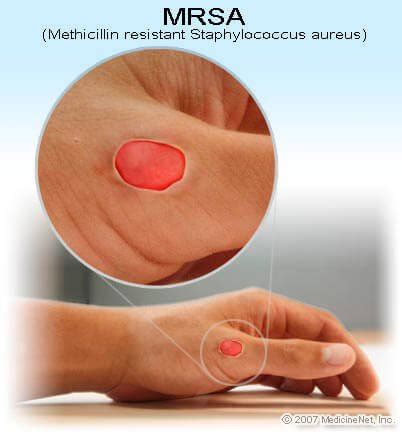 May 19, 2016 · boyce jm. Definition of MRSA infection