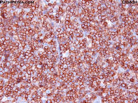Angioimmunoblastic t cell lymphoma (aitl) presents in older patients and the median age at diagnosis is approximately 60. Histopathology images of Angioimmunoblastic T-cell ...