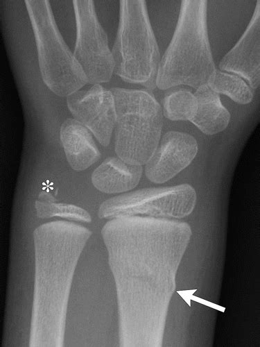 Styloid Process Of Ulna Fracture
