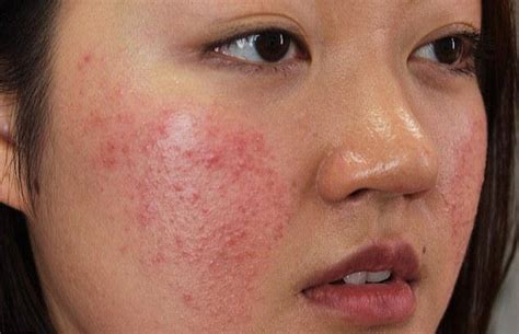 How To Recognize Cosmetic Skin Allergy And Effective Treatment