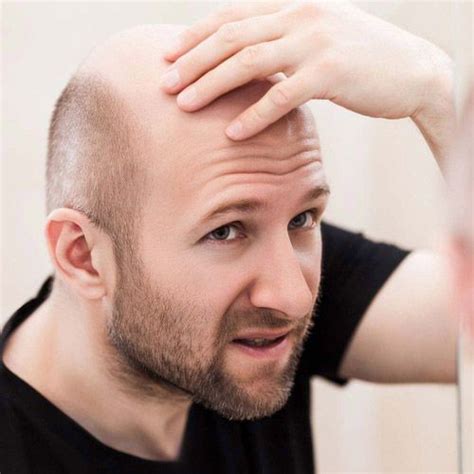 What Is Male Patern Baldness Causes Cure And More Man Matters