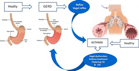 Acid Reflux And Asthma Symptoms