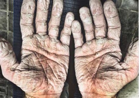 Olympic Rower Posts Jaw Dropping Picture Of Wrinkly Hands
