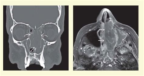 Sinonasal Non Hodgkin Lymphoma Radiology Key