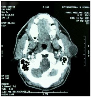 @inproceedings{prez2007adenomapb, title={adenoma pleomorfo benigno contralateral en glandulas parotida y. Quiste epidermoide en la región preauricular: Reporte de ...