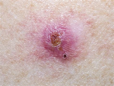 Pictures Of Skin Cancer Skin Cancer Examples Vrogue Co