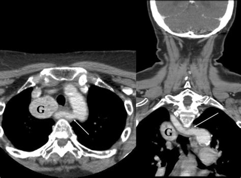 Preoperative Ct Scan Indicating A Mediastinal Goitre G And An