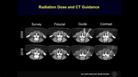 Ucsf Radiology Reducing Radiation Exposure In Ct Guided Injections