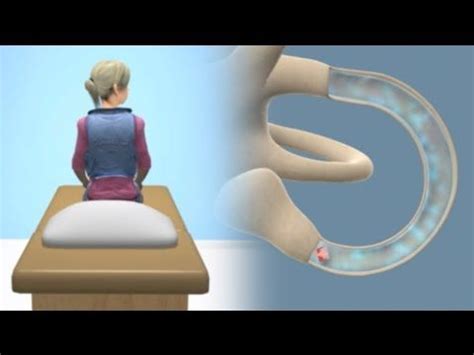 The epley maneuver (or epley's exercises) is a maneuver used to treat benign paroxysmal positional vertigo (bppv). http://www.FauquierENT.net - Video demonstrates how the ...