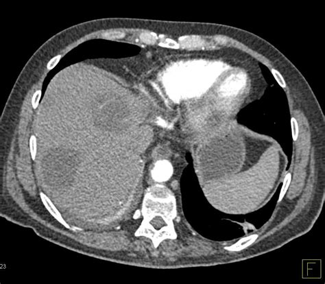 Incidental Right Pericardial Cyst Chest Case Studies Ctisus Ct Scanning
