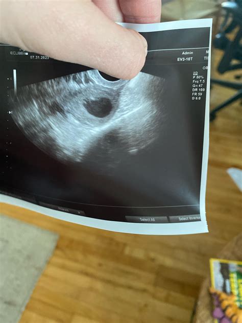 5w4d ultrasound showed only gestational sac, no pole or yolk sac. But