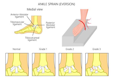 Ankle Strains Or Inversion Injuries Buxton Osteopathy Clinic