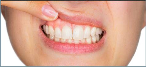 Calcium Therapy For Gum Disease Fortinsky Dentistry