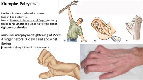 Hand Deformities Upload
