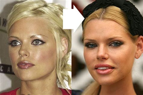 Chatter Busy Sophie Monk Plastic Surgery