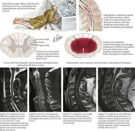Trauma To The Spine And Spinal Cord Clinical Gate