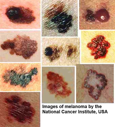 Melanoma Skin Cancer Diagram