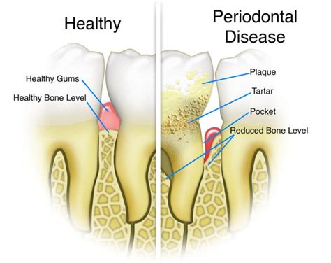 What Is Periodontal Disease Parker Periodontics And Implant
