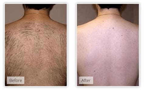 Hair removal creams remove the pubic hair fast and without pain. » LASER HAIR REMOVAL