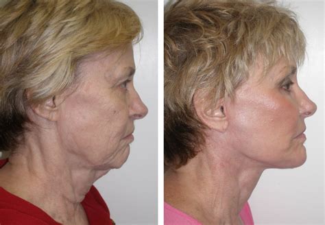 Before And After Face And Neck Lift With Cheek And Chin Implant And