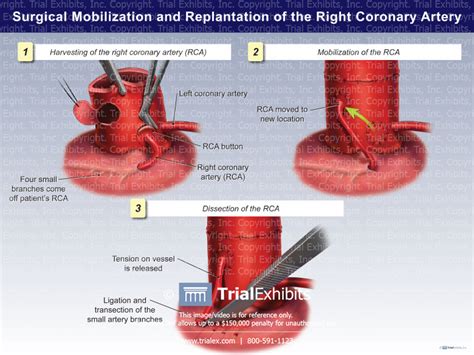 Surgical Mobilization And Replantation Of The Right Coronary Artery