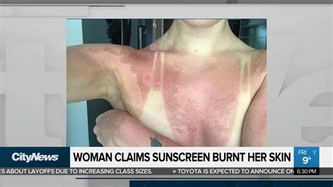 Woman Says Adverse Reaction To Sunscreen Left Her With Burn Youtube