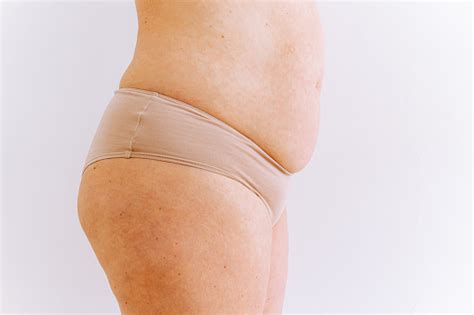 Saggy Stretched Belly Sagging Skin With Age Spots On Fat Belly Plastic