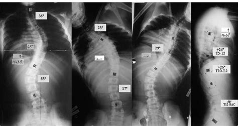The Lenke Classification System For Adolescent Idiopathic Scoliosis Neupsy Key