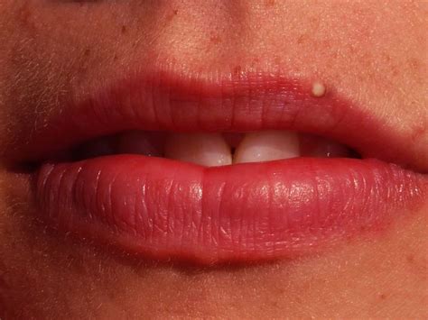 A Pimple On Lip Causes And Remedies Sjogrens Syndrome Sjogrens Dry Skin Care