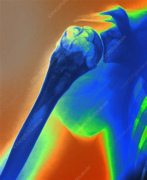 Aneurysmal Bone Cyst X Ray Stock Image C0528213 Science Photo