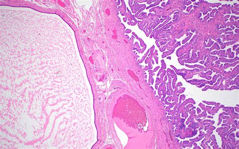 Fallopian Tube Cyst Histology