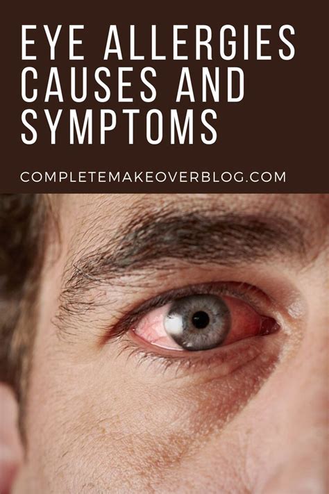 Eye Allergies Causes And Symptoms Eye Allergy Symptoms Allergy Eyes Cure For Allergies