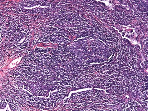 Benign Lymphoproliferative Disorders Of The Lung Benign