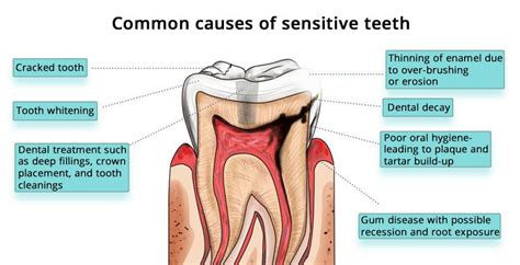 how to cure sensitive teeth goalrevolution0