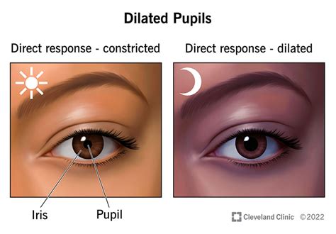 Dilated Pupils Mydriasis What Is It Causes What It Looks Like