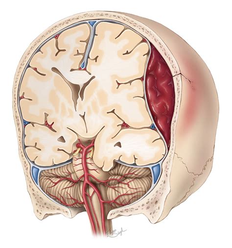 Epidural Hematoma The Neurosurgical Atlas By Aaron Cohen Gadol M D