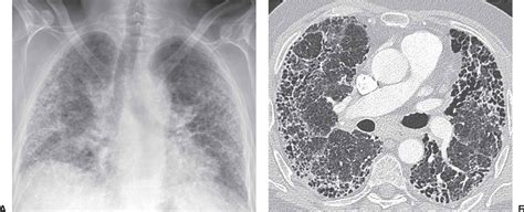 Interstitial Lung Disease Chest X Ray