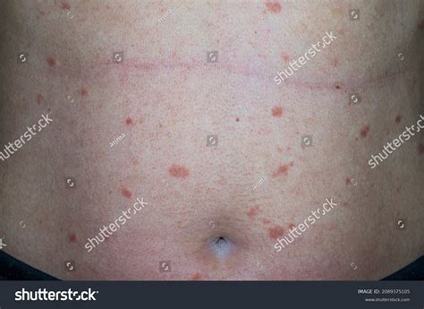 Virus Abdomen Infection Pityriasis Rosea Gibert Stock Photo Edit Now