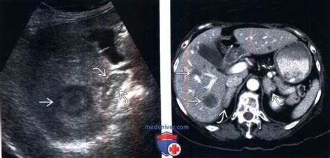 КТ, МРТ, УЗИ при гиперплазии надпочечников Картинка - КТ, МРТ, УЗИ при гиперплазии надпочечников