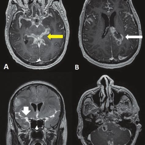 A D Follow Up Mri Brain Post Contrast Axial T1 A B D Showing