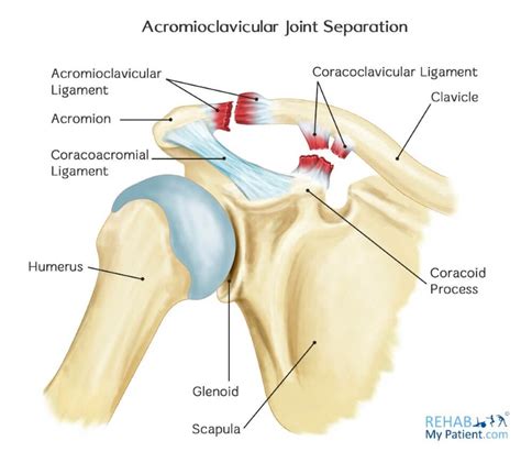 Ac joint separations are common in the ed. Shoulder Separation - Dr. Groh