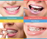 How Much Do Braces Cost With Insurance For Adults