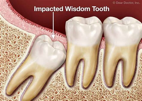 Wisdom Tooth Extraction Joseph Hudgins Orthodontics Carbondale Illinois